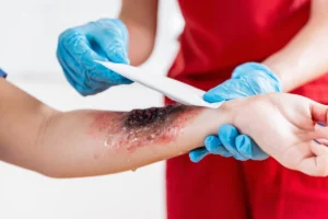 Dangers of Electrical Burn Injuries at Work